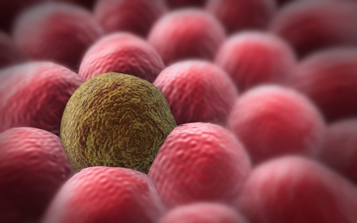 Cellule tumorali (foto: @Ugreen depositphotos)